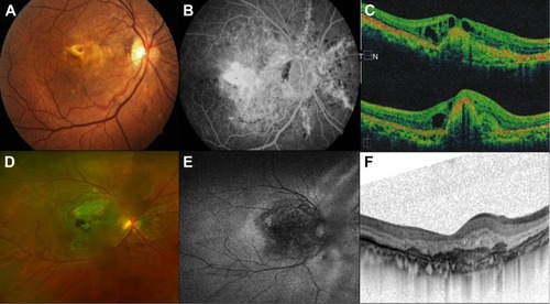 Figure 3 Case 1. Fifty-two-year-old male who complained of metamorphopsia and decrease of visual acuity as chief complaint.