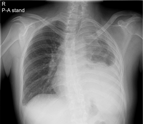 Figure 5 Chest X-ray.