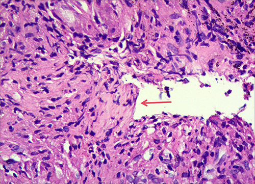 Figure 2 Hematoxylin-eosin staining of the mediastinal lymph nodes (10 × 20) exhibiting granulomatous inflammation (red arrow).