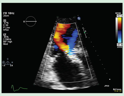 Figure 1. Transthoracic echocardiogram demonstrating a significant paravalvular leak, post-transcatheter aortic valve implantation.