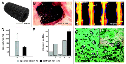 Figure 7. In vivo study large animals: created 3 cm orthotopic critical size defect (tibia) in sheep. Implantation of Coll I/CS coated PCL scaffolds over 12 and 48 weeks, five animals per group and time point. (A) Thirty piled scaffolds forming a 3-dimensional implant. (B) Three centimeter long mid-diaphysial defect in the sheep tibia filled with 30 piled scaffolds. (C) Radiological investigation (false coloring) of four sheep tibia defect areas showing two tibial defects were bridged completely after 12 mo (2 and 4). One showed a hypertrophic non-union (1) and one an atrophic non-union (3). (D) The quantification of the bone volume ratio after 12 mo shows the newly formed bone averaged 172% (+/− 86%) as compared with the intact contra lateral tibiae used as a reference value (100%). (E) Biomechanical evaluation at 12 mo (maximum load until failure) demonstrated that two operated tibiae (1 and 4) reached 49% (2,880 N) and 63% (3,720 N) of the reference value for non-operated bone respectively (c.r., 100%, 5,875 N). The values in the other two animals (2 and 3) reached 18% (1,050 N) and 7% (428 N). (F) Trichrome Masson-Goldner staining. Bone formation took place directly around the scaffold fibers revealing no interconnected gaps. The newly formed lamellar bone inside the scaffolds presented osteons including Haversian canals suggesting regular bone formation. According to their natural localization, osteocytes (ocy) and osteoblasts (obl) could be localized within the bone or at the adjacent areas. The scaffold was completely vascularized (bv) and erosion of the PCL fibers was clearly visible. No inflammatory reaction was evident around the implant material after 12 mo.