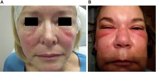 Figure 2 Acute generalized facial edema.