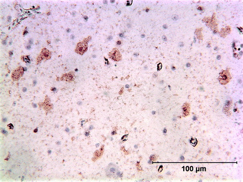 Figure 8.  Immunoperoxidase-stained cerebrum of a scarlet macaw (Case 1458) showing multiple cells containing ABV N-protein scattered through the cerebral tissue.