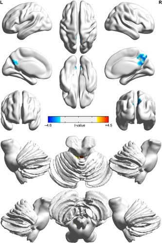 Figure 2 Significant activity differences were observed in PCC, precuneus, and brainstem between COPD patients and NCs groups (two-tailed, voxel-level P<0.01; GRF correction, cluster-level P<0.05) are shown in three-dimensional image.