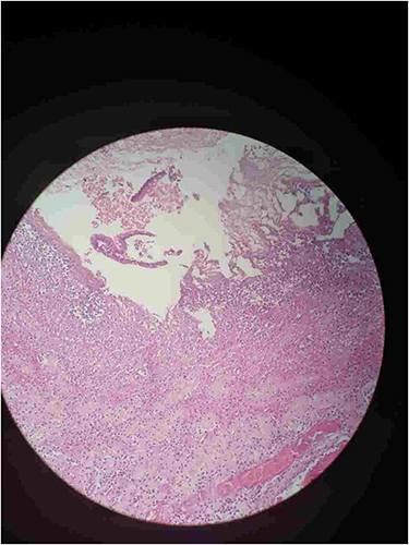 Figure 6 Section taken from narrowed segment shows ulcerated mucosa and transmural neutrophilic infiltration.