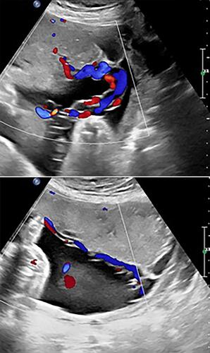 Figure 4 Monochorionic diamniotic twin gestation with reverse twin arterial perfusion (TRAP) sequence at 32 and 1/7 weeks’ gestation. Upper panel: Note furcate, marginal insertion of umbilical cord of the pump (normal twin). Lower panel: The umbilical cord of the pump twin feeds directly to the umbilical cord of the acardiac twin’s placenta. The short and hypocoiled umbilical cord of the acardiac twin (image) contains two vessels and does not communicate with the placenta.