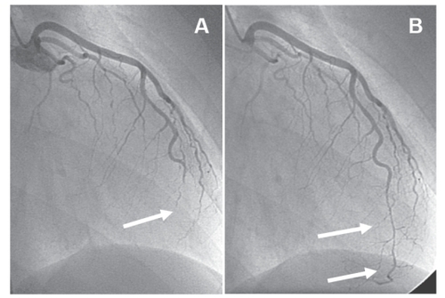 Figure 1 Angiogram of the left coronary artery. The left anterior descending coronary artery (LAD) is distally occluded (arrow in A); after intracoronary application of nitroglycerine the LAD is open (arrows in B), but demonstrating a long, severely diseased coronary segment that is significantly stenosed. Because of the long coronary segment involved, the small diameter and the suspicion of inflammatory origin of the stenosis, percutaneous coronary intervention was not attempted.