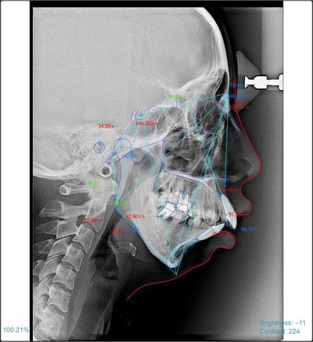 Figure 2 Class II skeletal malocclusion with great value of ANB, Go2, and Yaxis-SN.