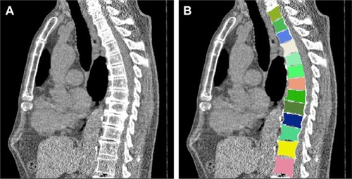 Figure 2 Images of thoracic vertebral bodies for measurement of computed tomography attenuation.