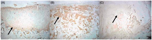 Figure 4. (A) In the 24th week, the type-II collagen immunohistochemical staining of the TEC group showed strongly positive result, and the scope of staining was consistent with that of HE staining in the 24th week (×40). (B) In the 24th week, the type-II collagen immunohistochemical staining of the Nano-HA/PLLA group showed that the pores of scaffold were still visible (×40). (C) In the 24th week, the type-II collagen immunohistochemical staining of the control group showed that the center was sunken and the margins were uneven (×40).