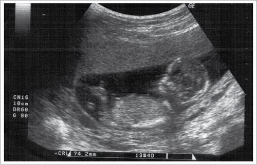 FIGURE 2. 13 weeks 4 days fetus with upper limb hemimelia.