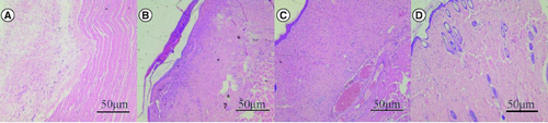 Figure 5. Effect of human umbilical cord mesenchymal stem cells combined with small porcine intestinal submucosa on inflammatory cells (H&E staining ×200).(A) Blank control group. (B) Small porcine intestinal submucosa group. (C) Human umbilical cord mesenchymal stem cell group. (D) Human umbilical cord mesenchymal stem cells combined with small porcine intestinal submucosa group (scale bar = 50 μm).