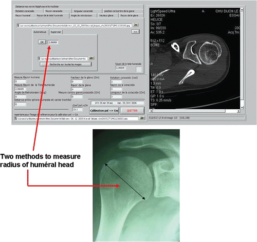 Figure 8. Automatic and supervised extraction of the humeral head radius. [Color version available online.]