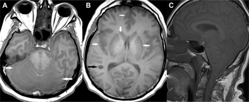 Figure 4 Unenhanced T1-weighted axial images of brain (A and B) and sagittal image of brain and cervical spinal cord (C) showing hypointensities involving cerebral and cerebellar cortex and white matter, basal ganglia, thalami, and brainstem bilaterally (solid white arrows). A focal hypointense lesion is noted in the right temporal periventricular white matter (black arrow). The cervical spinal cord is swollen and reveals hypointense signals within it (open white arrows).