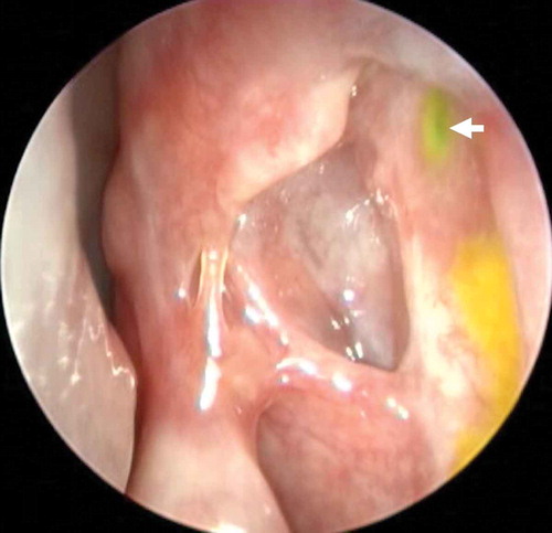 Figure 3. Functional endoscopic dye test (FEDT): Fluorescein is instilled into inferior fornix and its flow observed with endoscope through the internal common opening (ICO) (white arrow). A well healed large ostium located anterior to axilla of middle turbinate, quick flow of dye through ICO, dynamic ICO without any granuloma are some of the features of overall good ostium.