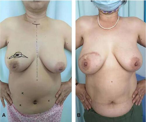 Figure 4 Comparison diagrams: before and after omentum breast reconstruction. (A) Before operation. (B) After operation.