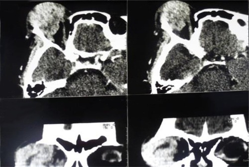 Figure 2 CT scan of the orbits.