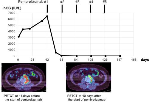 Figure 2 Clinical course of treatment with pembrolizumab. Since the patient’s hCG level started to re-increase after spontaneous regression continued for 8 months, immunotherapy with pembrolizumab was started. The hCG level decreased from 6500 to <1.0 IU/L after two doses of pembrolizumab. PET-CT 40 days after the start of treatment showed shrinkage of RPLN metastases with diminished metabolism.