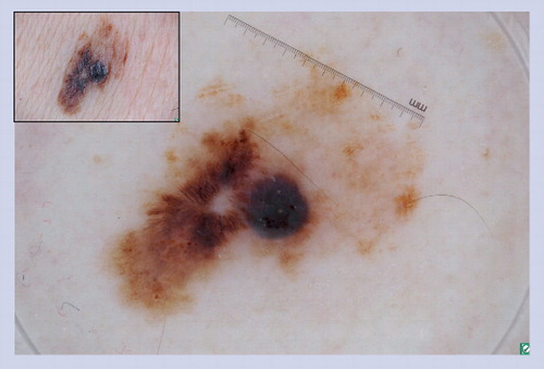 Figure 17. Superficial spreading melanoma.These lesions often manifest the clinical ABCD features of melanoma, and under dermoscopy they often display some of the structures listed in Table 3 that heighten the suspicion of melanoma. This particular lesion has atypical dots and globules, irregular network with branched streaks and an irregular blotch. Superficial spreading melanomas are not commonly found in children.