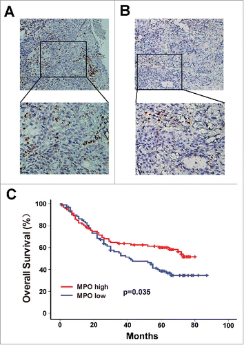 Figure 1. Infiltration of MPO+ neutrophils into tumor nests and its association with survival in ESCC patients. The MPO+ neutrophils in ESCC surgical specimens were detected by immunohistochemistry. According to the median count of MPO+ cells, the patients were divided into a high MPO+ infiltration group (A) and a low MPO+ infiltration group (B). Upper panels, × 200 magnification; lower panels, × 400 magnification. (C) Survival analysis shows that overall survival (OS) was significantly improved in the high MPO+ infiltration group compared to the low MPO+ infiltration group.