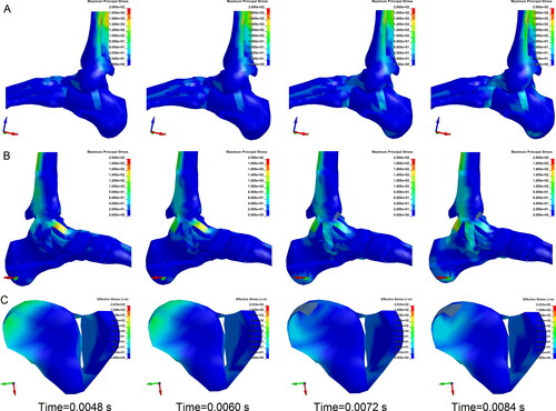 Figure 7. Stress contours of ligaments and tibia (anterior-posterior, A-P impact on lower leg). (A) Contour of lateral ligaments’ maximum principal stress. Maximum principal stress increased in the talofibular ligament. (B) Contour of medial ligaments’ maximum principal stress. Maximum principal stress of the anterior deltoid ligament obviously increased, indicating a high risk of injury. (C) Contour of effective stress in the distal tibia and fibula. Effective stress of the medial part of the distal tibia, where pulling by anterior deltoid ligament increased and caused avulsion fracture. (Each column is at the same time point).