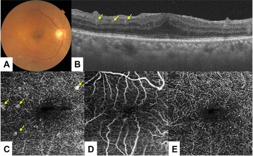 Figure 1 A 74-year-old woman presented with a six-month history of ocular sarcoidosis. Fundus examination of the right eye was unremarkable (A). On spectral-domain OCT and 3×3 mm macular cube OCT angiography conducted in the right eye, however, granulomatous-like lesions were evident in the deeper retinal plexus (B, C: yellow arrow), but not in the superficial plexus (D). After systemic corticosteroid treatment, these lesions were resolved completely (E).
