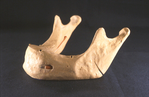 Figure 2. Phantom model of the lower jaw with a radiologically detectable copper wire representing the inferior alveolar nerve and an artificial mandibular angle fracture. [Color version available online.]