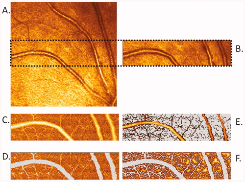 Figure 3. Images scanned by Heidelberg Retina Flowmetry and calculated by Automatic Full Field Perfusion Image Analyser (AFFPIA; by J.M.H.). (A) Life image with area of scanning (marked by dots). (B) Reflexion image. (C) Perfusion image. (D) Perfusion area selected for analysis with exclusion of saccades, over- and underexposed pixels, as well as vessels with diameter over 20μm. (E) Automatic calculated image of vessels with diameter over 10μm. (F) Automated calculated image of intercapillary area.