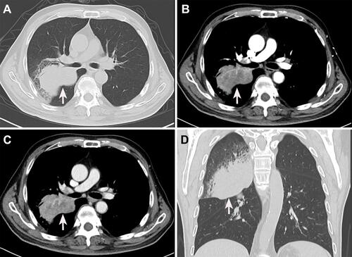 Figure 2 Preoperative enhanced computed tomography images of the chest. (A) A plain chest CT scan reveals a mass-like lesion in the right upper lung with an irregular margin (white arrow). (B) The mass is markedly enhanced in the arterial phase (white arrow). (C) The enhancement of the venous phase is slightly weaker than that of the venous phase (white arrow). (D) Coronal sections reveal an irregular lesion in the right upper lung.