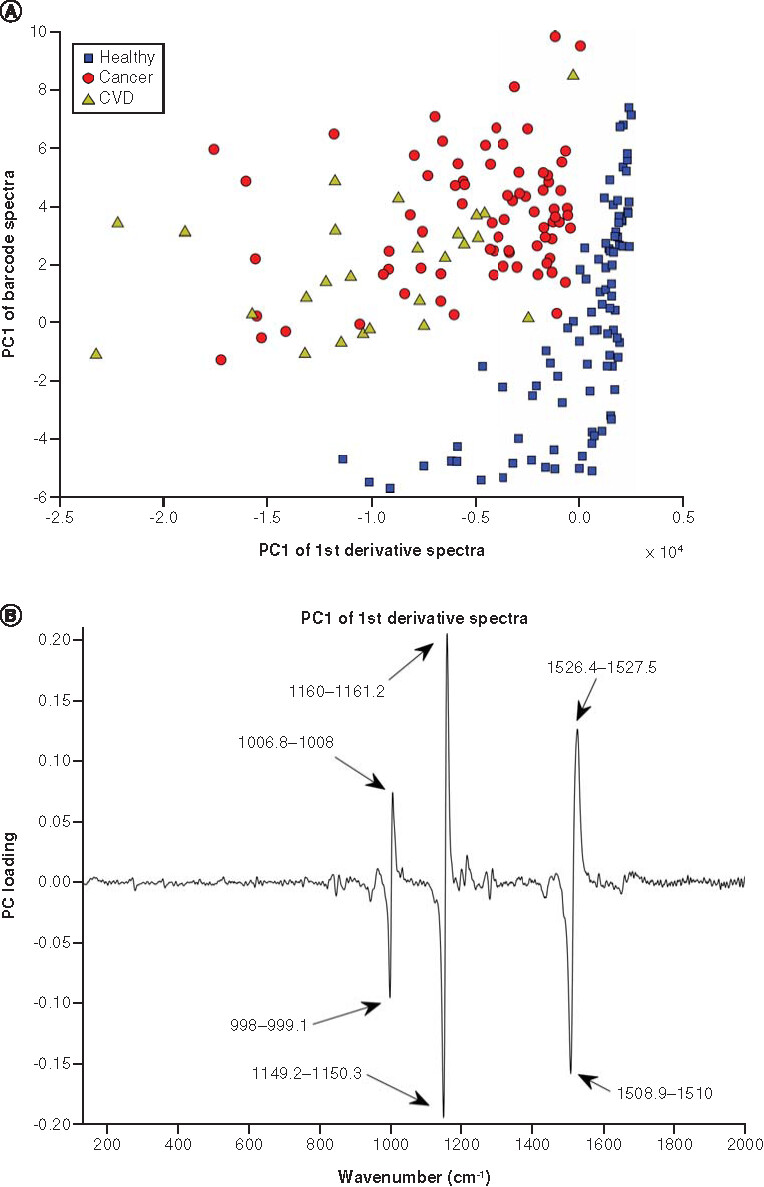 Figure 3. nanoSERS discrimination between healthy, CVD and hematological malignancies using principal component analysis. (A) PC analysis scatter plot of the nanoSERs spectral data of the blood plasma samples of healthy controls, CVD patients, and cancer patients using the first derivative of PC1 and the barcoded spectra of PC1. (B) PC1 loading of first derivative.CVD: Cardiovascular disease; PC: Principal component.