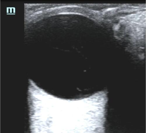 Figure 4 Point of care ultrasound image of vitreous detachment.