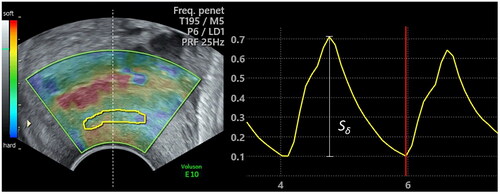 Figure 2. Left, B-mode image with the elastography color box superimposed on a cervix at gestational week 38. The ROI (yellow) is placed within the anatomical area of interest within the middle third of the anterior cervical lip. The probe-centerline is marked with the white dashed line. Right, in the resulting strain curve calculated by the GE-software, the strain peak height (Sδ) is marked.