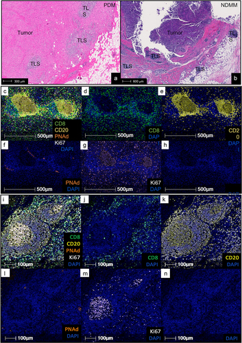Figure 1. Representative images of TLS in PDM and NDMM. Images from hematoxylin and eosin (H&E)-stained tumor sections show the location of TLS relative to tumor in PDM (A) and in NDMM (B). Multiplex and single marker images of TLS in PDM (C-H) and NDMM (I-N) show the markers evaluated in this study. Images are of the 5-color multiplex stain (C, I) as well as single marker stains depicting CD8 (D, J), CD20 (E, K), PNAd (F,L), and Ki67 (G,M) in combination with DAPI shown in blue and alone in (H, N). Marker colors and image magnifications are indicated.