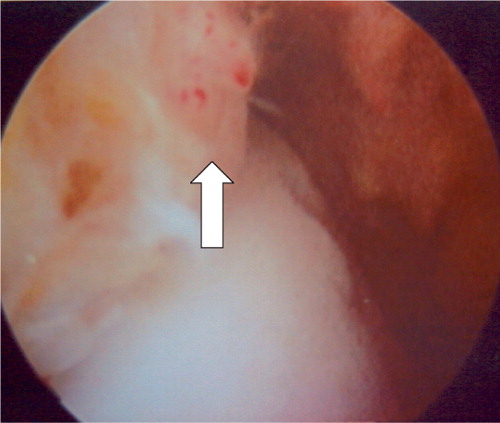 Figure 8. Case 3. Intraoperative arthroscopic appearance of the osteoid osteoma in the distal tibia. The elevated synovial lining is indicated by an arrow.