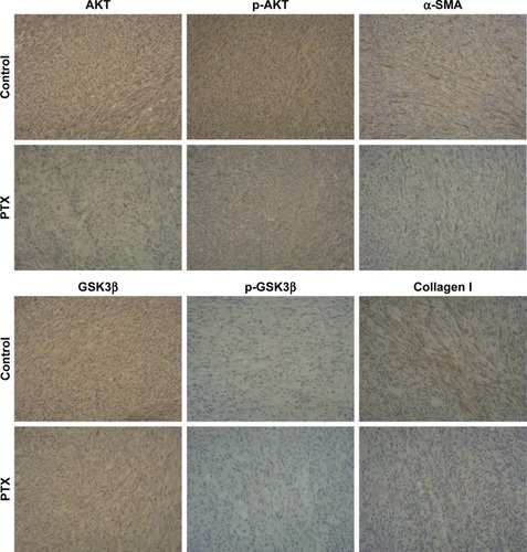 Figure 12 PTXL inhibits the activation of AKT/GSK3β signaling and the production of α-SMA and collagen I in keloids bearing in nude mice.Note: The female nude mice substance a keloid were treated with intralesional injection, the PTX group was treated with 100 µg/mL PTXL, the control group was treated with 5% glucose solution, injection volume is 0.05 mL/mm3, according to keloid volumes. Magnification×200.Abbreviations: α-SMA, alpha smooth muscle actin; AKT, protein kinase B; GSK3β, glycogen synthase kinase 3 beta; p-AKT, phosphorylation-protein kinase B; p-GSK3β, phosphorylation-glycogen synthase kinase 3 beta; PTX, paclitaxel; PTXL, paclitaxel–cholesterol-loaded liposomes.