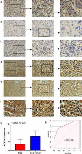 Figure 1. The expression level of ACE2 protein in hepatocellular carcinoma (HCC) and non-tumor liver tissues based on immunohistochemistry. Panels a-c: representative images of ACE2 protein expression in HCC tissues. Panels d-f: representative images of ACE2 protein expression in non-tumor normal liver tissues. In panels a-f, the magnifications of the three images of each panel are 100, 200, and 400 respectively. Panel g: ACE2 protein expression. Panel h: receiver operating characteristic (ROC) curve with area under the curve (AUC) of ACE2 protein expression in HCC tissues