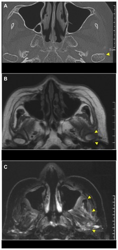 Figure 5 CT and MRI at 4-month follow-up after the first visit: (A) plain CT showing diffuse cortical bone resorption of the left condyle of the mandible; (B) MRI, with the left condyle of the mandible in part showing low-high signal intensity on a T1-weighted image; (C) MRI, with soft tissue around the left side of the ascending ramus of the mandible showing heterogeneous high-signal intensity on a fat-suppressed T2-weighted image.