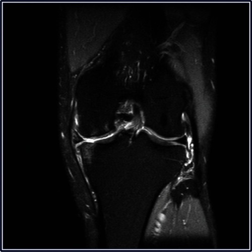 Figure 3 Magnetic resonance imaging of the left knee demonstrating a medial meniscal tear, herniation from the joint space with bone edema within the medial tibial plateau, and osteochondral damage on the medial femoral articular surface.