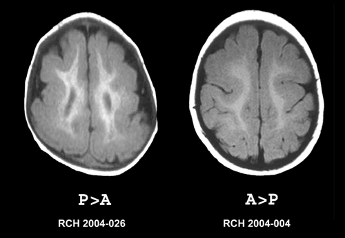 Figure 4. Imaging features of classical lissencephaly contrasting the P>A gradient with the A>P gradient. Axial T1 -weighted MRI scans. The image on the left shows near-complete agyria posteriorly transitioning to pachygyria anteriorly. This is the P>A gradient consistent with a mutation of the LIS1 gene. The image on the right shows severe pachygyria anteriorly transitioning to mild pachygyria posteriorly. This is the A>P gradient consistent with a mutation of the DCX gene. MRI, magnetic resonance imaging