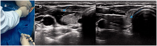 Figure 1. Hydrodissection by continuous injection. (a) Surgical assistant injects a mixture of 1% lidocaine and physiological saline solution into the surrounding thyroid capsule by continuous injection (volume: 50 ml, speed: 10–20 ml/min) during the ablation period, (b) achieving ‘hydrodissection’ (arrow) to protect the vital organs from thermal injury. (c) At the beginning of ablation, an MWA antenna was inserted into the nodule’s lower pole.
