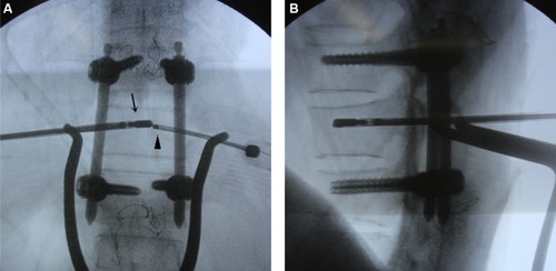 Figure 1 Microwave ablation therapy for breast cancer thoracic metastasis ([A] anteroposterior film; [B] lateral film).Note: The microwave ablation needle (arrow) inserts into vertebral metastases by the pedicle with C arm-assisted navigation for improving accuracy of position, and thermal sensor (arrow head) is situated in the vertebral center, monitoring the vertebral center temperature.