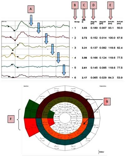 Figure 5 Components of the hemifield sector/hemi-ring analysis printout. Analysis components; color-coded averaged waveforms from the sector or hemi-ring (A), sector/hemi-ring waveform numbers (B), average SNR value for each sector/hemi-ring (C), positive peak amplitude (D), positive peak latency (E), color-coded sectors for comparison (F), color-coded hemi-rings for comparison (G).