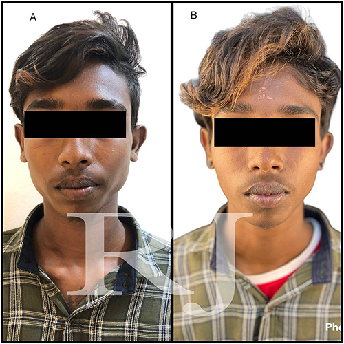 Figure 2 (A) Pre-treatment frontal view of the patient with bilateral masseter hypertrophy. (B) Post-treatment frontal view at 6-month follow up.