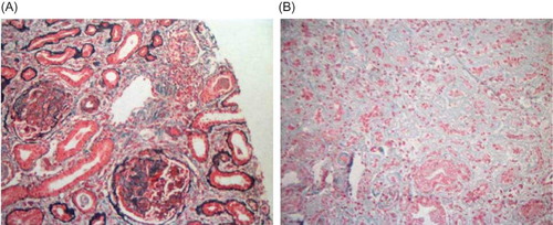 Figure 2.  Renal biopsy showing tubulointerstitial nephropathy. (A) Glomerulus with a focal necrotizing lesion and fibrous crescent (periodic acid Schiff-hematoxylin stain; ×100 magnification). (B) Tubulointerstitial lesion manifested as diffuse interstitial fibrosis and tubular atrophy (Masson stain; ×100 magnification).