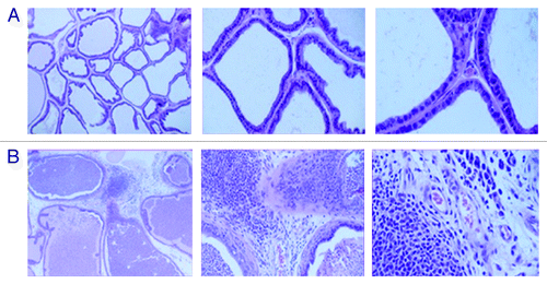 Figure 1. (A) Histological staining of prostate tissue from control rats immunized with dendritic cells pulsed with PAP (in the absence of GM-CSF) were indistinguishable from the normal architecture of the prostate. (B) Histological staining of prostate tissue from rats immunized with PAP+GM-CSF-pulsed dendritic cells a total of 3 times with 2-week intervals. (reproduced from Sims RB, 2011Citation52)