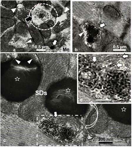 Figure 10. a – d: FOG and SO muscle fibers of adult obese female Zucker rat. Among the crowded intermyofibrillar mitochondria, degraded structures (arrowheads) bearing some concentric membrane whorls or stacks revealed what could be a filing by highly electron dense contrasted droplets ranging from 8–20 nm in diameter alongside those membranes (white arrows). d: Enlarged view of c demonstrates the centripetal-like trend of the aggregated deposits while becoming centrally coalescent and, thus, widened