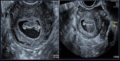 Figure 1. Showed an intrauterine pregnancy at the transverse view of the uterus by the trans-vaginal scan, (fetal pole) shown at the same view.