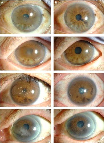 Figure 2 Representative images of eyes with BSK before (A) and after (B) EDTA chelation. The patient’s symptoms resolved completely after the procedure.