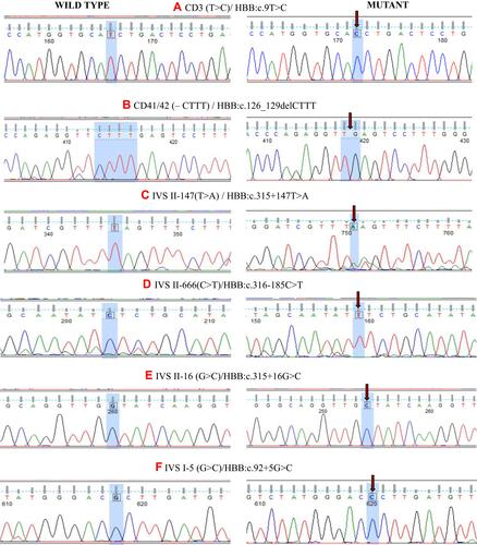 Figure 1 Chromatograms of DNA sequences depicting the HBB Mutations at different positions. (A) Codon 3 (T>C) and (B) Codon 41/42 (-CTTT), mutations are present in exons, while (C–F) are the presentation of mutations that are present in intronic region of β-globin gene. Red arrows are used for marking the exact position of mutations. Sequence analysis was done using Finch TV 1.4.0. (FinchTV chromatogram viewer is a popular desktop application, developed by Geospiza, Inc.).