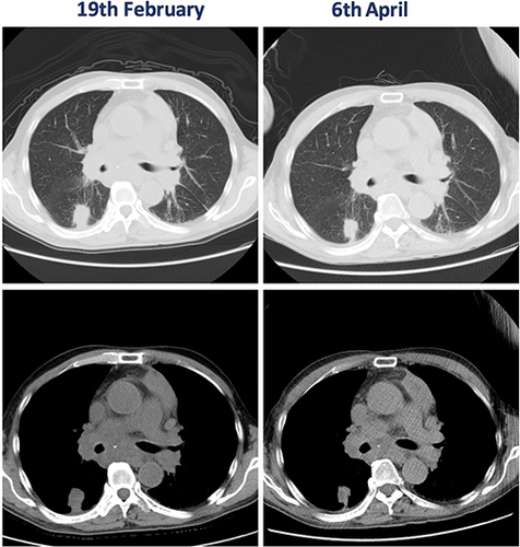 Figure 3 CT scans of the tumor before and after treatment with Sintilimab.